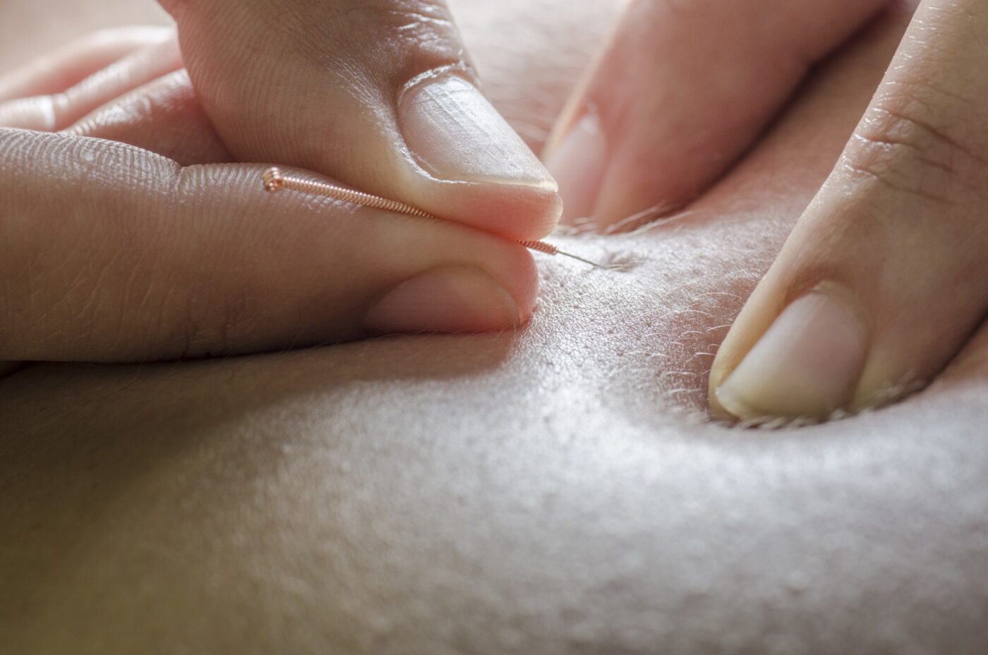 Dry needling