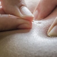 Bilde av kurs i Dry needling